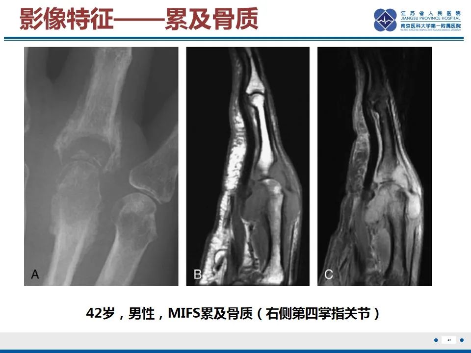 影像PPT - 【PPT】黏液炎性纤维母细胞性肉瘤-42