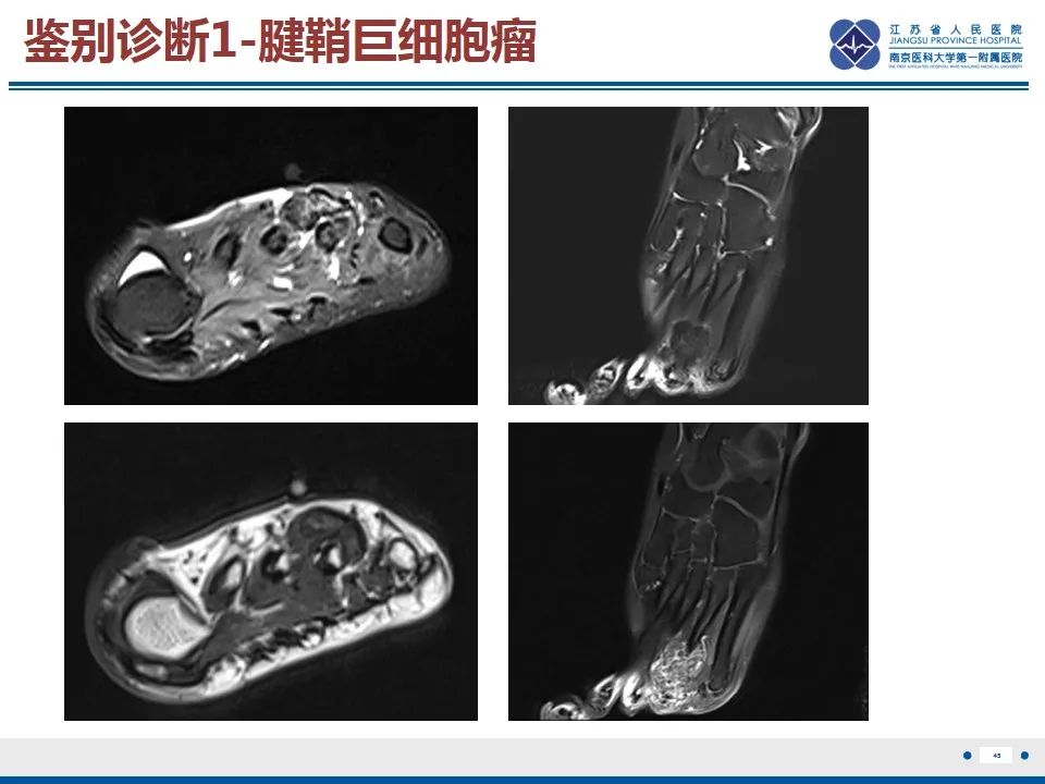 影像PPT - 【PPT】黏液炎性纤维母细胞性肉瘤-46