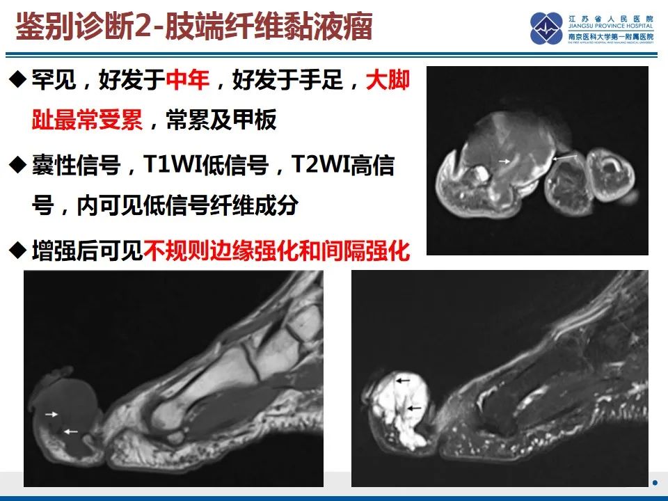 影像PPT - 【PPT】黏液炎性纤维母细胞性肉瘤-47