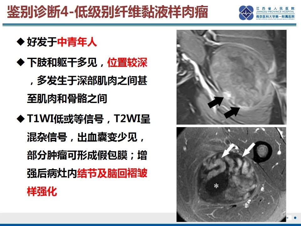 影像PPT - 【PPT】黏液炎性纤维母细胞性肉瘤-49