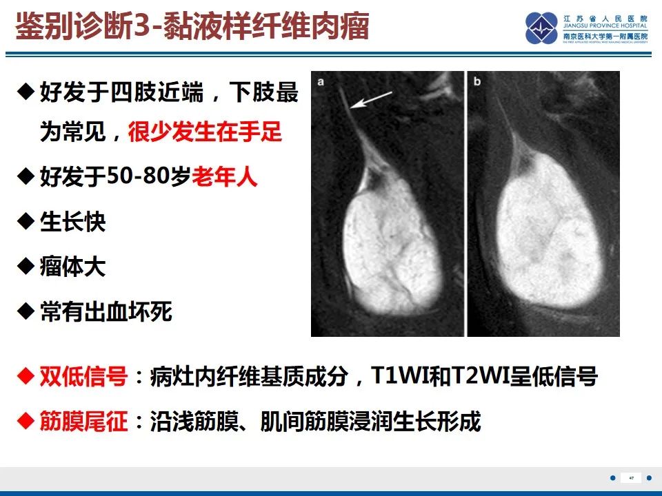 影像PPT - 【PPT】黏液炎性纤维母细胞性肉瘤-48