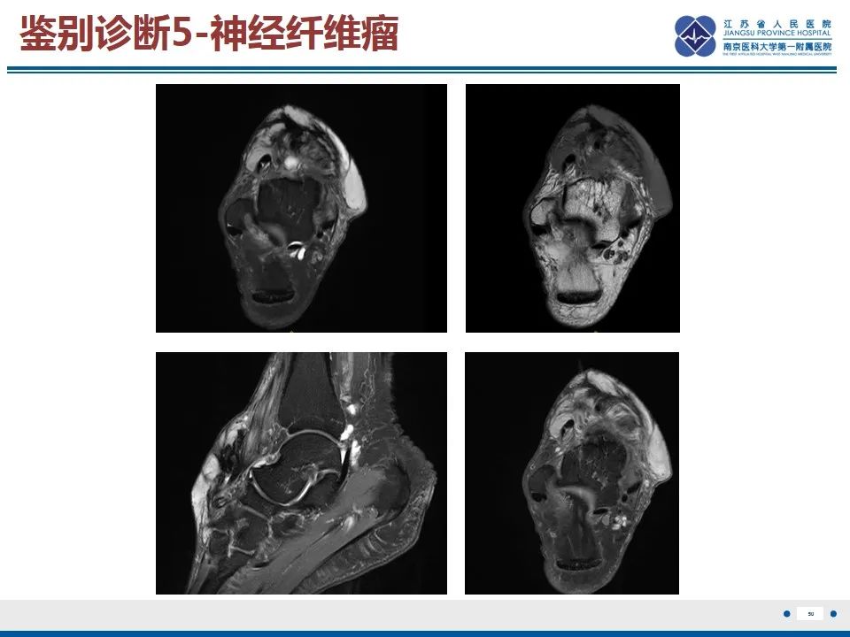 影像PPT - 【PPT】黏液炎性纤维母细胞性肉瘤-51