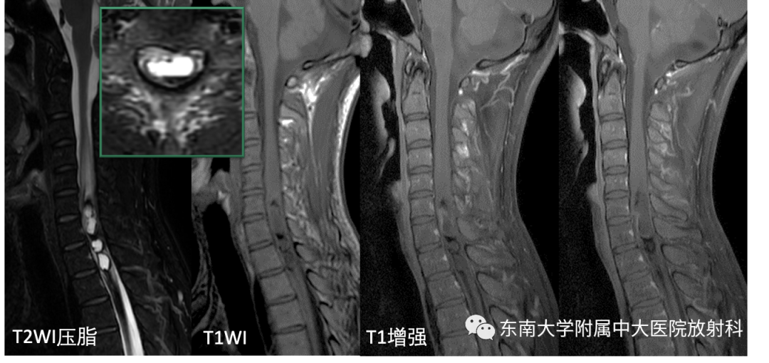 影像PPT - 【PPT】脊髓室管膜瘤-1