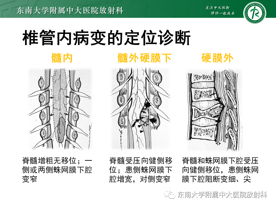 影像PPT - 【PPT】脊髓室管膜瘤-4