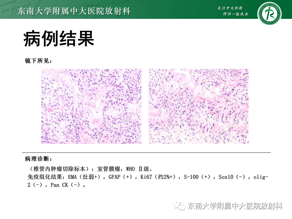 影像PPT - 【PPT】脊髓室管膜瘤-2