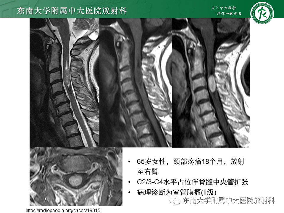 影像PPT - 【PPT】脊髓室管膜瘤-10