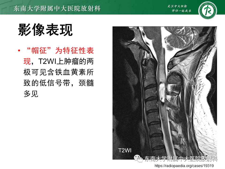 影像PPT - 【PPT】脊髓室管膜瘤-11