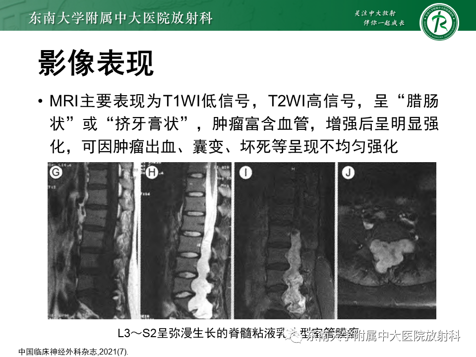 影像PPT - 【PPT】脊髓室管膜瘤-14