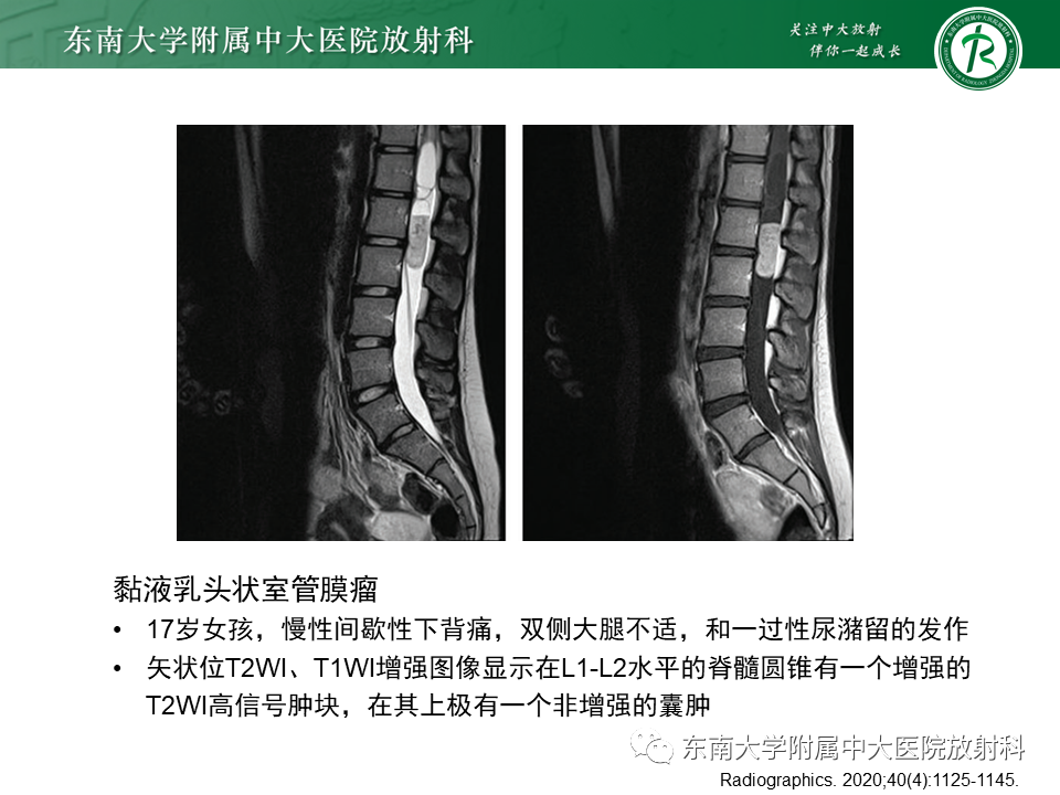 影像PPT - 【PPT】脊髓室管膜瘤-15