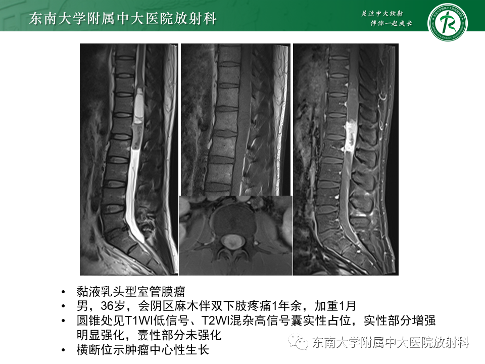 影像PPT - 【PPT】脊髓室管膜瘤-16