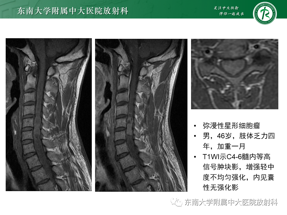 影像PPT - 【PPT】脊髓室管膜瘤-20