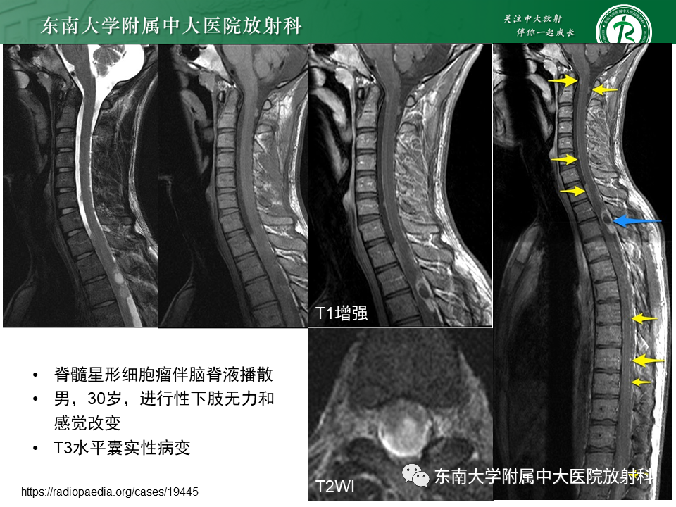 影像PPT - 【PPT】脊髓室管膜瘤-21