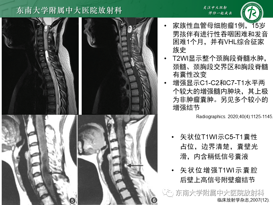 影像PPT - 【PPT】脊髓室管膜瘤-25