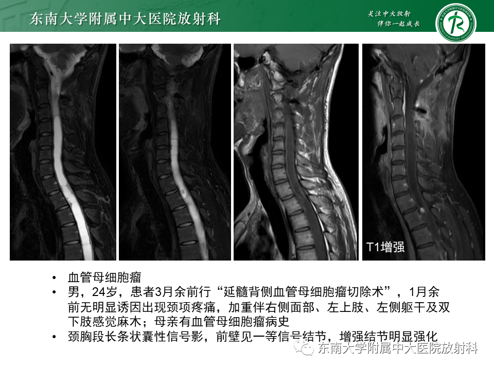 影像PPT - 【PPT】脊髓室管膜瘤-24