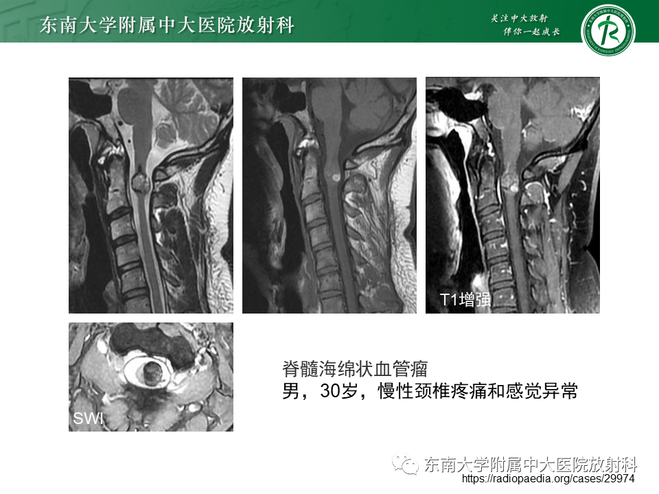 影像PPT - 【PPT】脊髓室管膜瘤-27