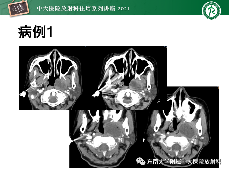 影像PPT - 【PPT】咽旁间隙肿瘤的定位与诊断-4
