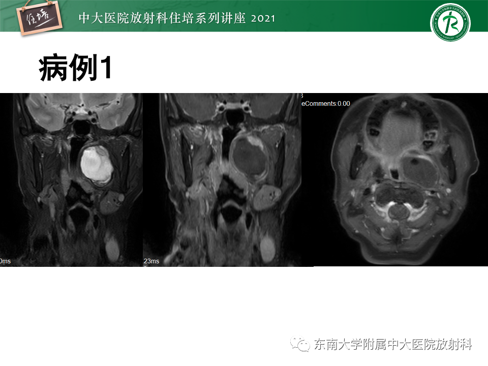 影像PPT - 【PPT】咽旁间隙肿瘤的定位与诊断-5