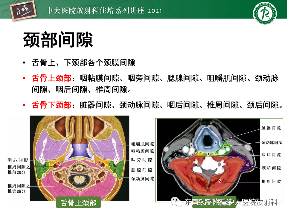 影像PPT - 【PPT】咽旁间隙肿瘤的定位与诊断-7