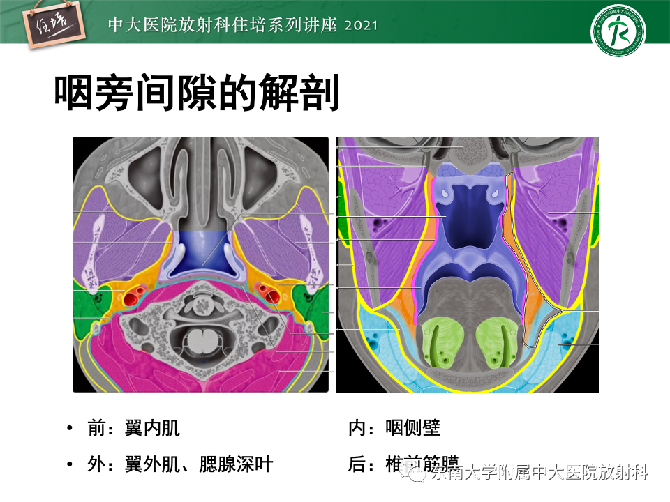 影像PPT - 【PPT】咽旁间隙肿瘤的定位与诊断-9