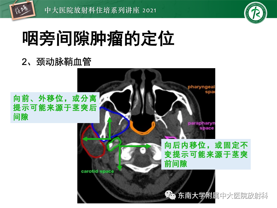 影像PPT - 【PPT】咽旁间隙肿瘤的定位与诊断-15