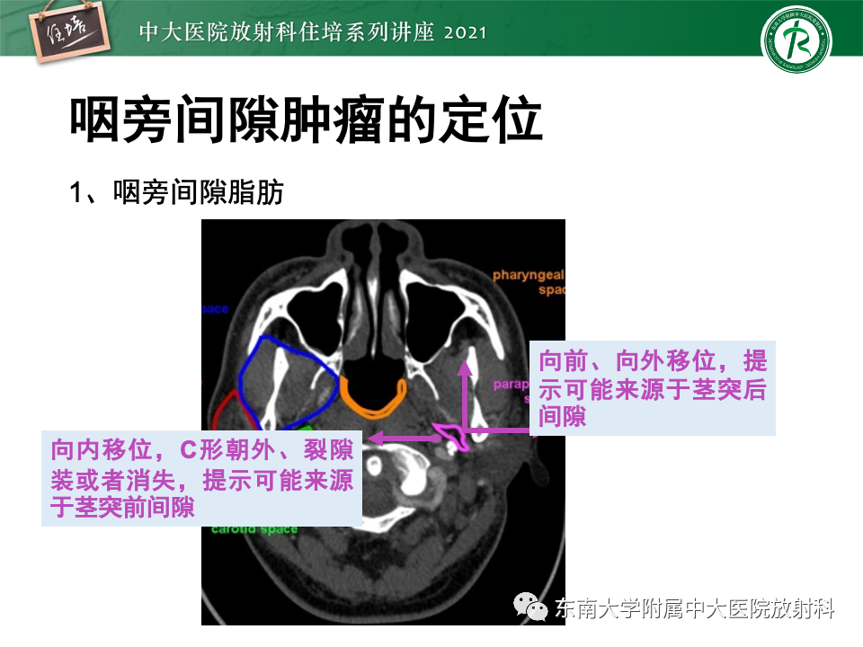 影像PPT - 【PPT】咽旁间隙肿瘤的定位与诊断-14