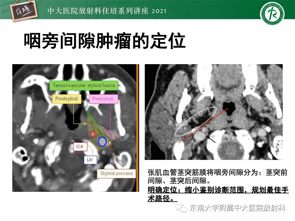 影像PPT - 【PPT】咽旁间隙肿瘤的定位与诊断-12
