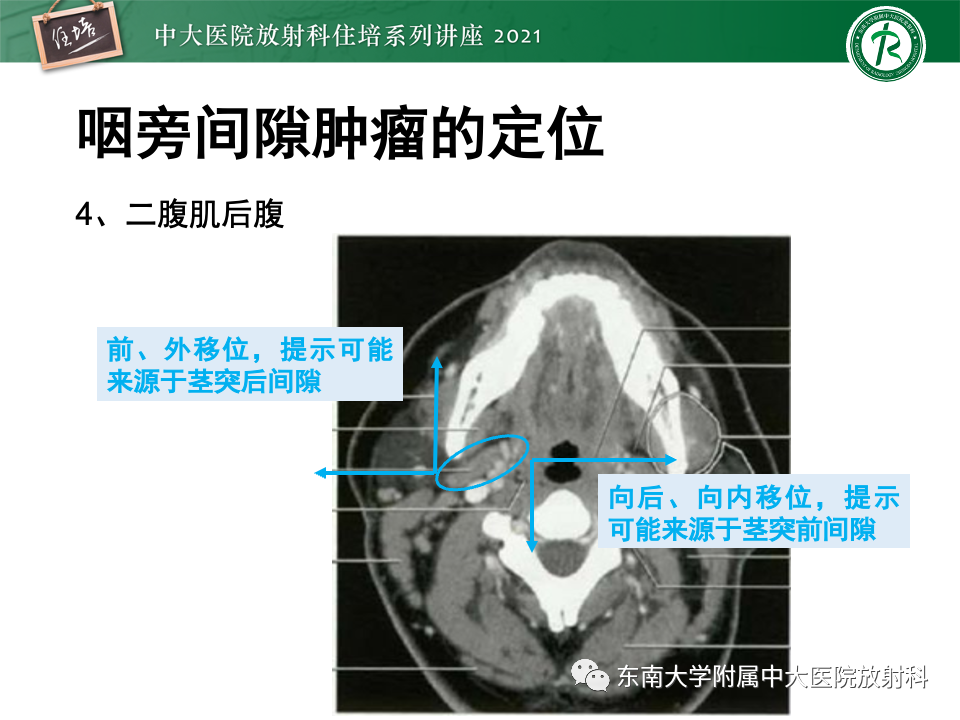 影像PPT - 【PPT】咽旁间隙肿瘤的定位与诊断-17