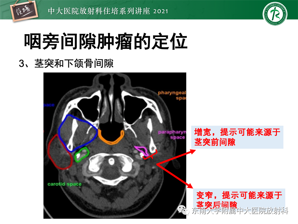 影像PPT - 【PPT】咽旁间隙肿瘤的定位与诊断-16