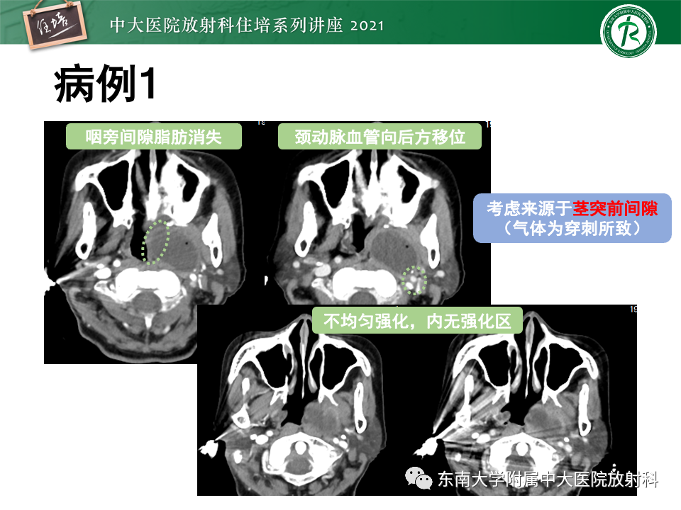 影像PPT - 【PPT】咽旁间隙肿瘤的定位与诊断-20