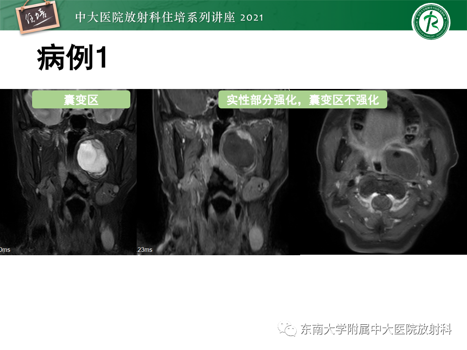 影像PPT - 【PPT】咽旁间隙肿瘤的定位与诊断-21