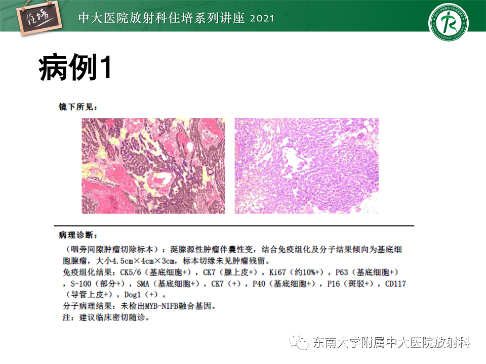 影像PPT - 【PPT】咽旁间隙肿瘤的定位与诊断-22