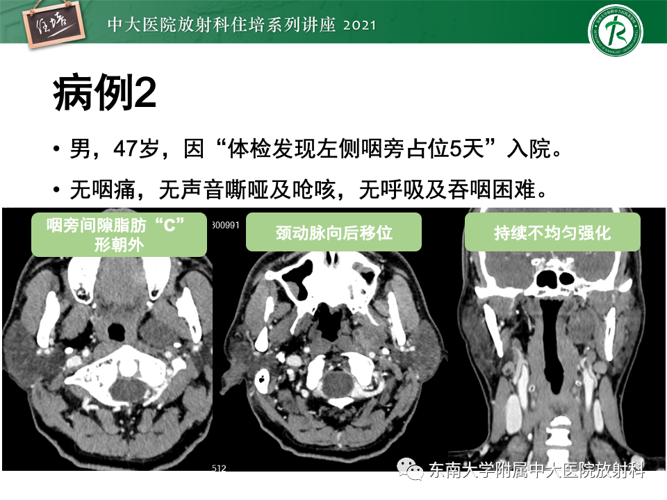 影像PPT - 【PPT】咽旁间隙肿瘤的定位与诊断-25