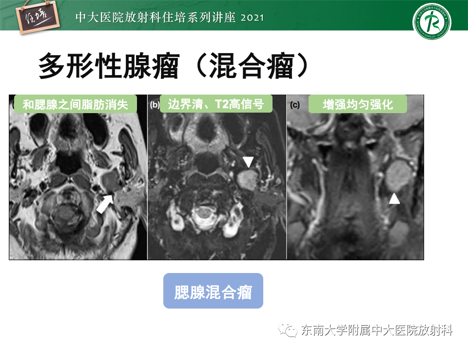 影像PPT - 【PPT】咽旁间隙肿瘤的定位与诊断-24