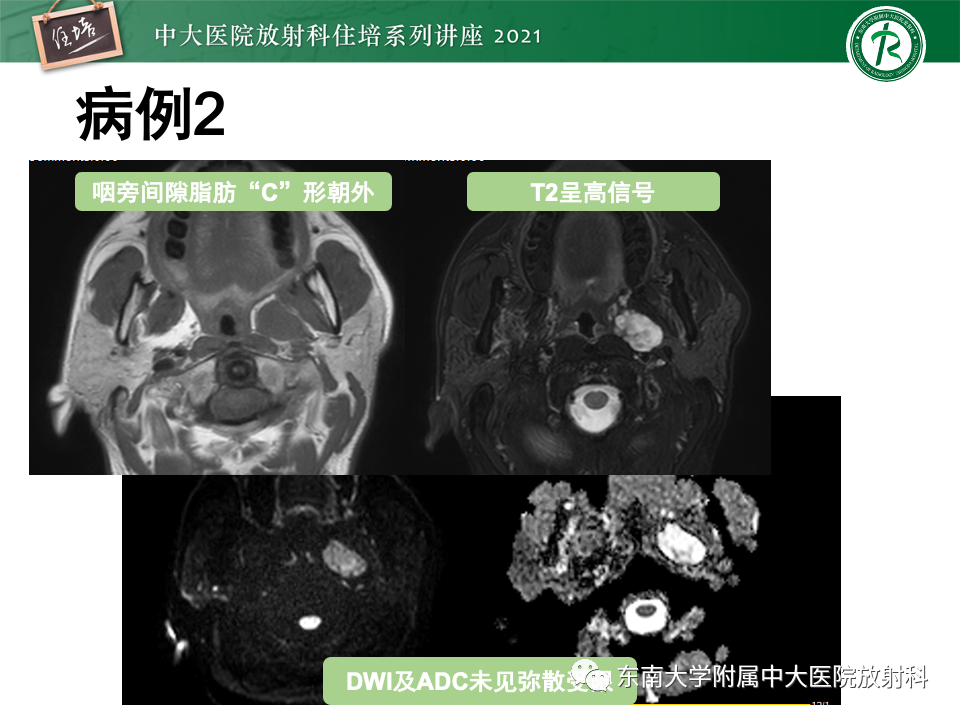 影像PPT - 【PPT】咽旁间隙肿瘤的定位与诊断-26
