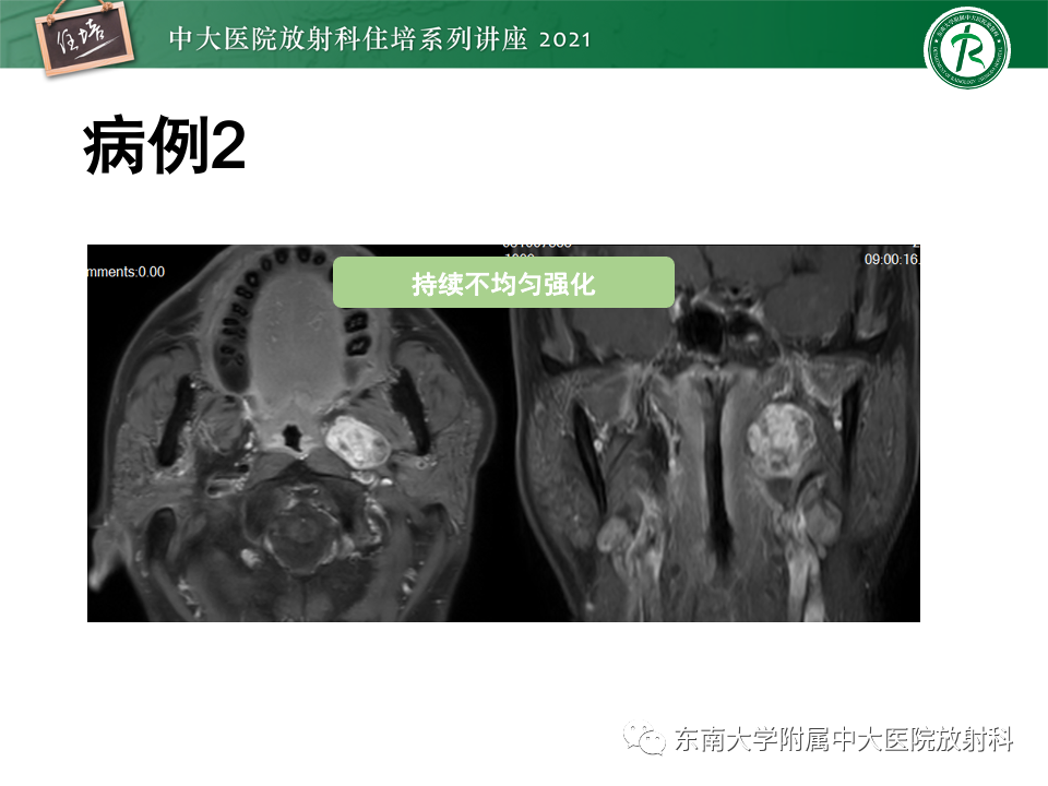 影像PPT - 【PPT】咽旁间隙肿瘤的定位与诊断-27