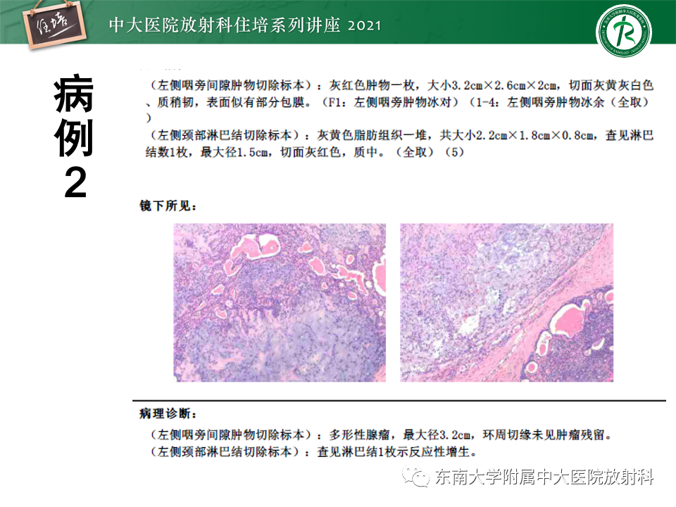 影像PPT - 【PPT】咽旁间隙肿瘤的定位与诊断-28