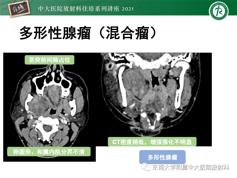 影像PPT - 【PPT】咽旁间隙肿瘤的定位与诊断-29
