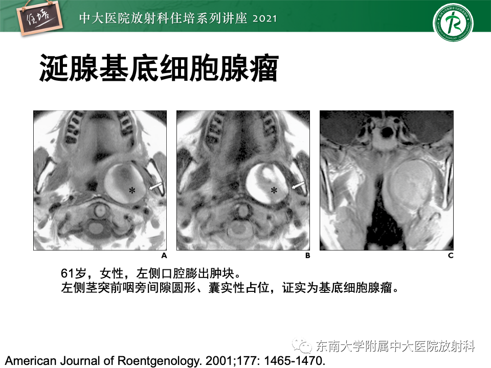 影像PPT - 【PPT】咽旁间隙肿瘤的定位与诊断-32