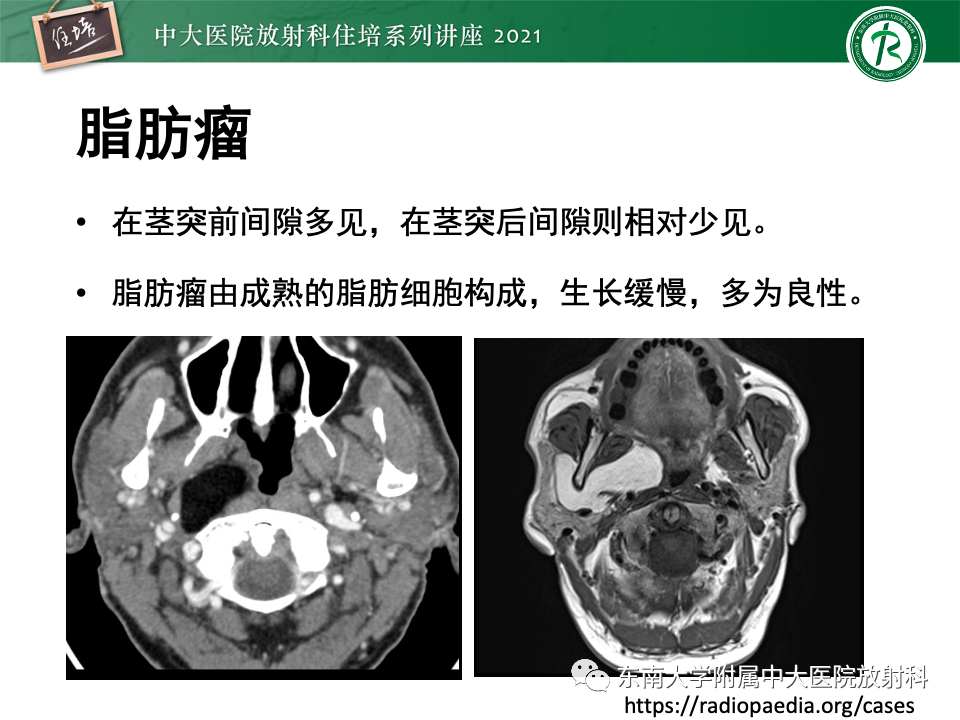 影像PPT - 【PPT】咽旁间隙肿瘤的定位与诊断-33