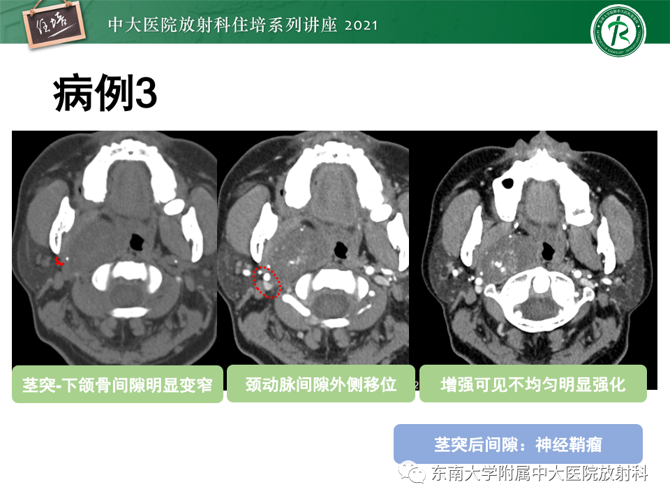 影像PPT - 【PPT】咽旁间隙肿瘤的定位与诊断-38