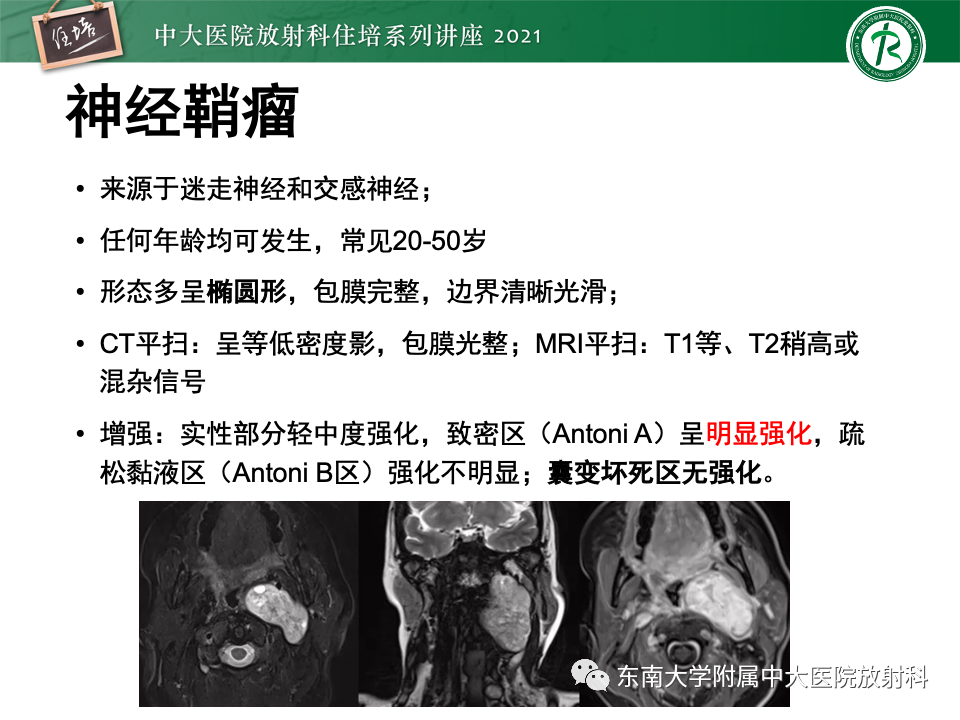影像PPT - 【PPT】咽旁间隙肿瘤的定位与诊断-36