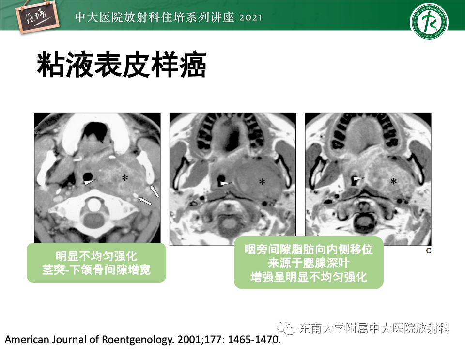 影像PPT - 【PPT】咽旁间隙肿瘤的定位与诊断-35
