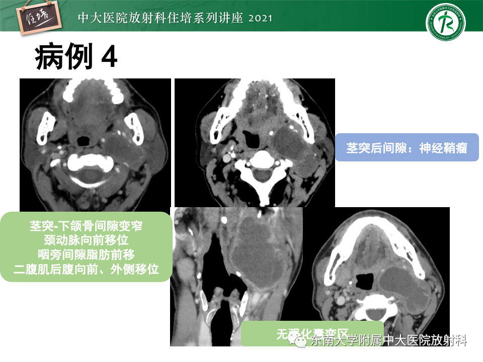 影像PPT - 【PPT】咽旁间隙肿瘤的定位与诊断-40