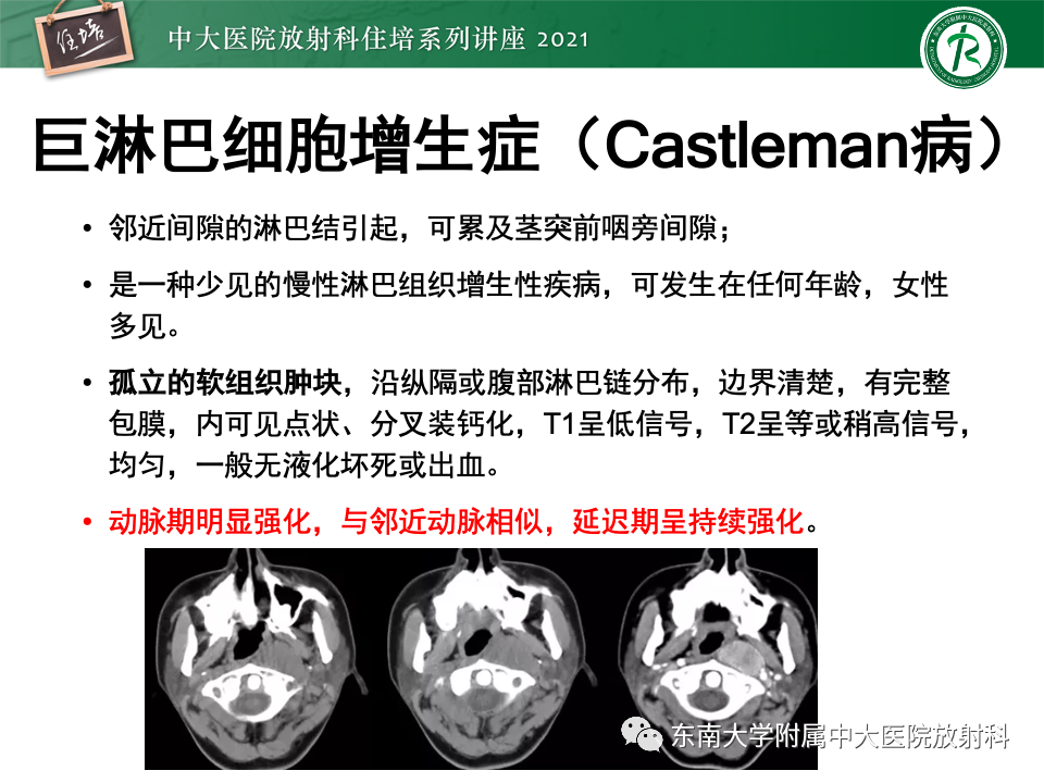 影像PPT - 【PPT】咽旁间隙肿瘤的定位与诊断-41