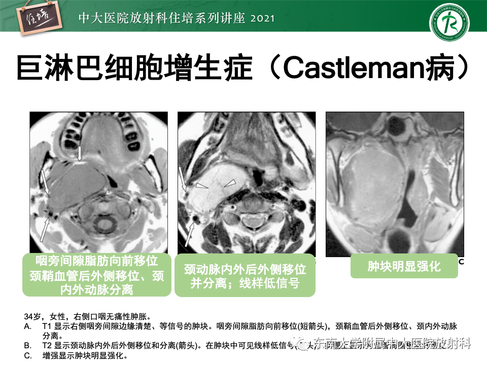 影像PPT - 【PPT】咽旁间隙肿瘤的定位与诊断-42
