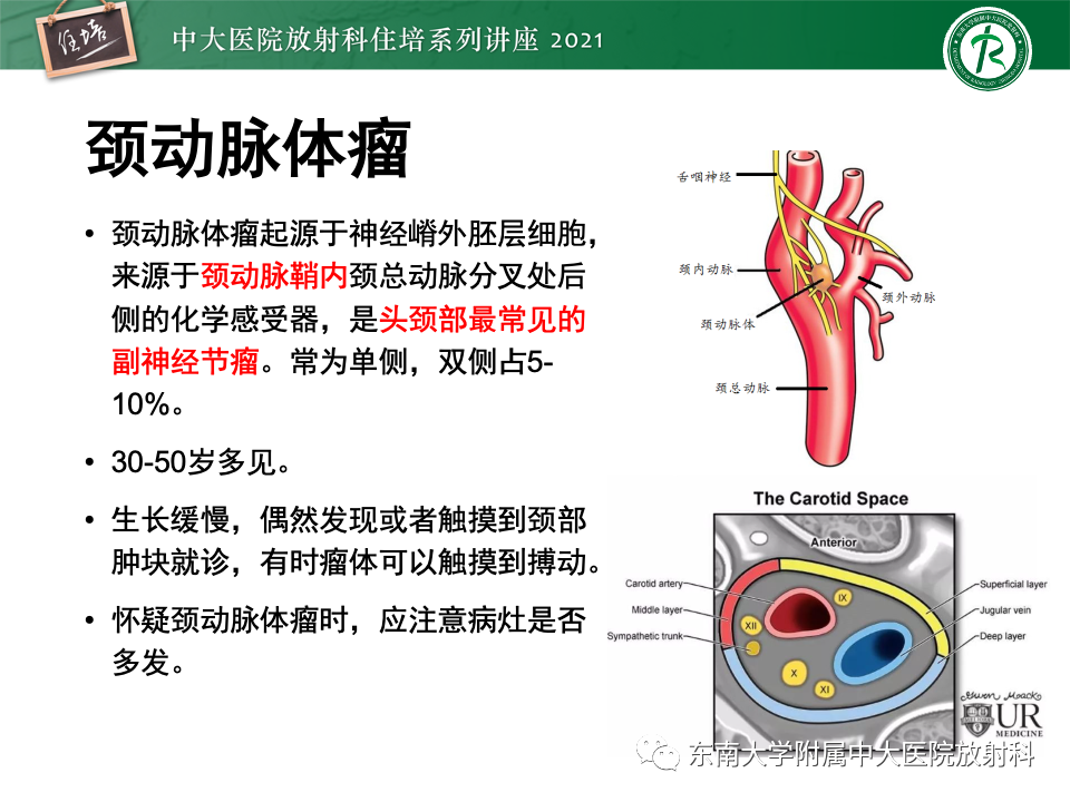 影像PPT - 【PPT】咽旁间隙肿瘤的定位与诊断-43