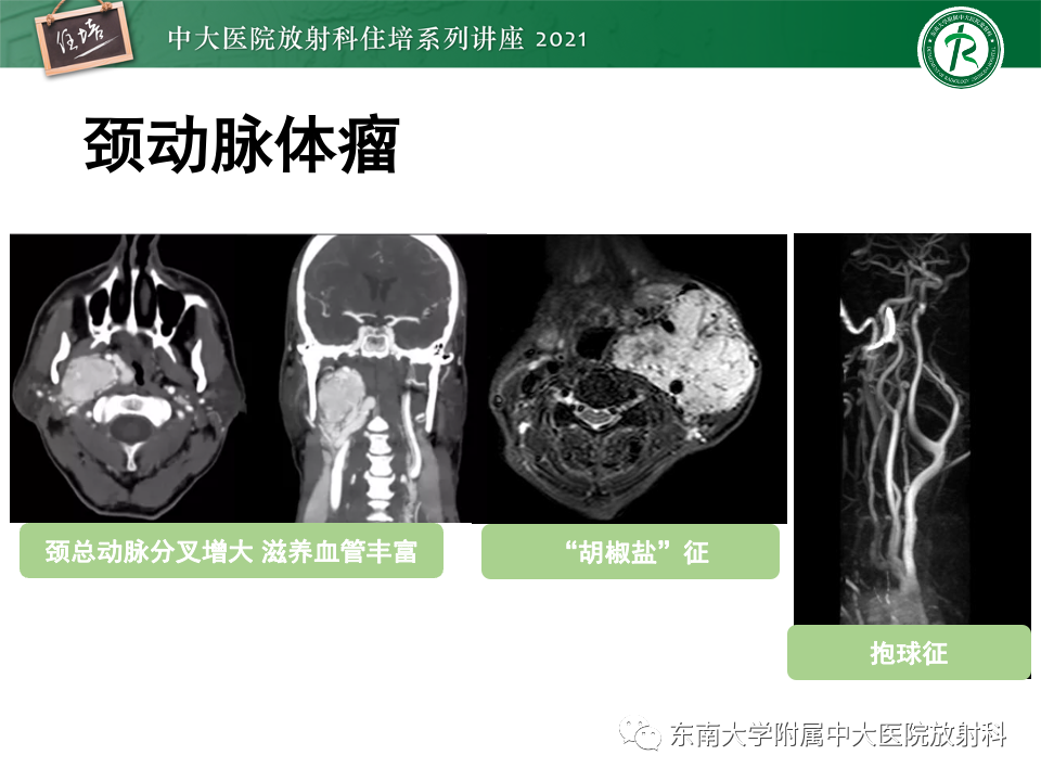 影像PPT - 【PPT】咽旁间隙肿瘤的定位与诊断-45