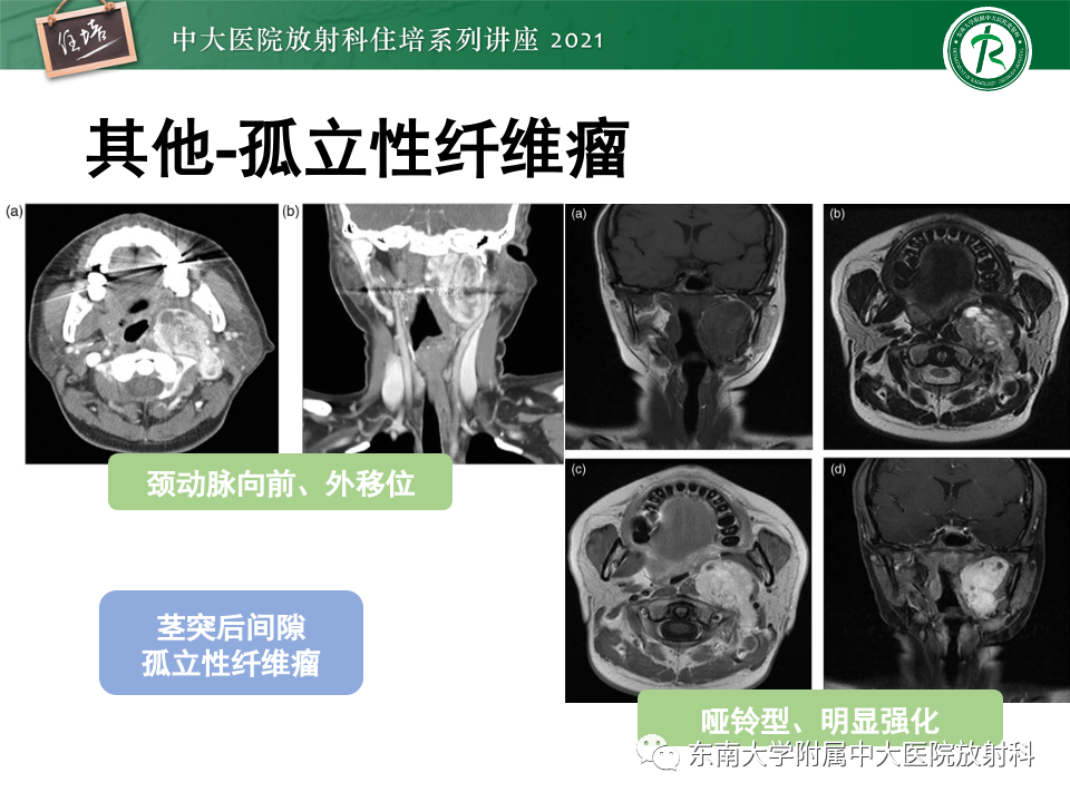影像PPT - 【PPT】咽旁间隙肿瘤的定位与诊断-47