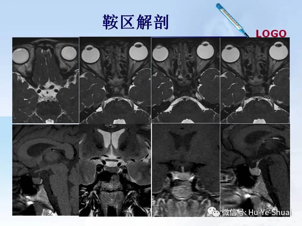 影像PPT - 【PPT】鞍区肿瘤的MRI诊断-5