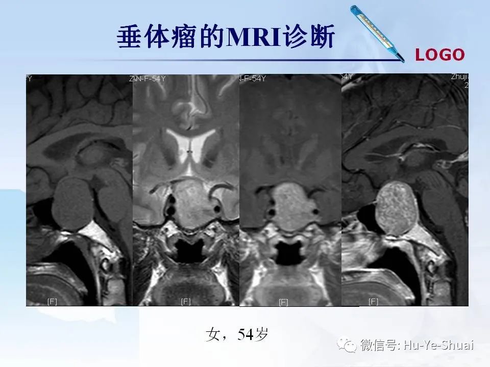 影像PPT - 【PPT】鞍区肿瘤的MRI诊断-12